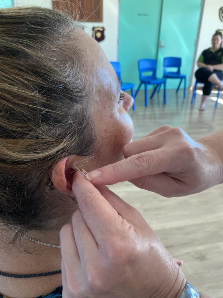 ear acupuncture perth